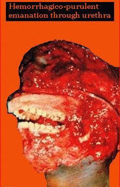 Blenorrhagical Spermatocystitis : Hemorrhagico - Purulent Emanation Through Urethra